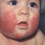 Chàm đỏ bẩm sinh là bệnh gì, chữa trị ra sao?