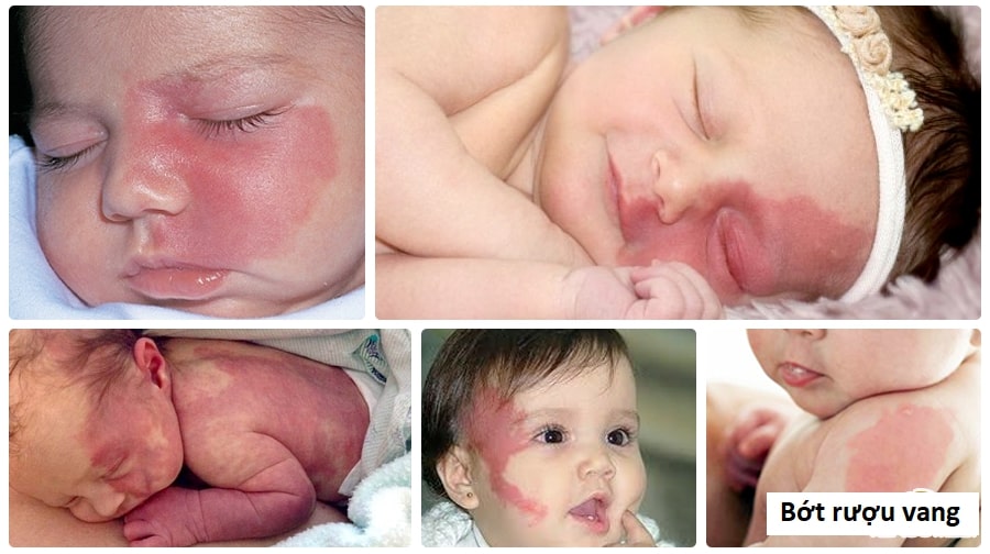 Chàm đỏ bẩm sinh 2