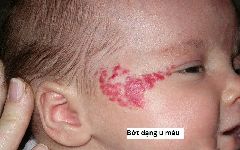 Chàm đỏ bẩm sinh 3