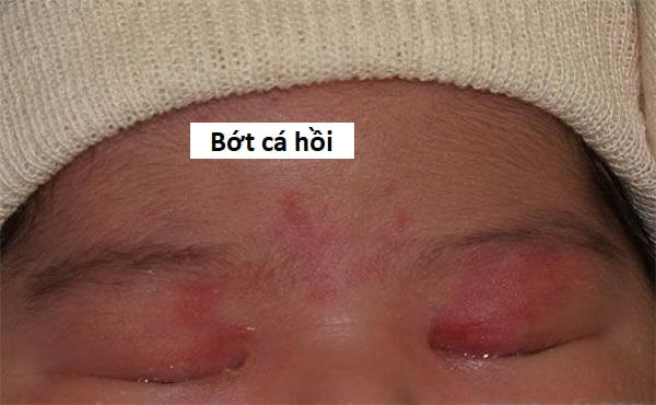 Chàm đỏ bẩm sinh 4