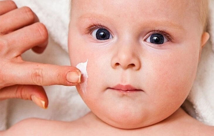 Chàm đỏ bẩm sinh 5