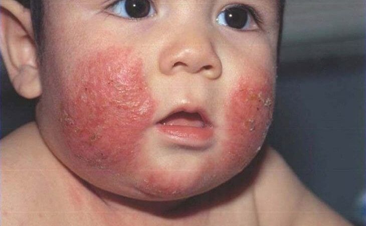 Chàm đỏ bẩm sinh là bệnh gì, chữa trị ra sao?