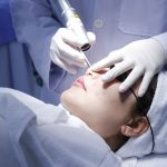 Điều trị bớt bẩm sinh bằng laser: Tất tần tật điều nên biết