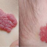 Trẻ sơ sinh có vết đỏ sau gáy là bệnh gì, có sao không?