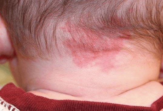 trẻ sơ sinh có vết đỏ sau gáy 3