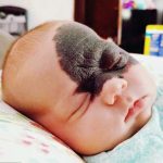 Vết bớt màu đen: Nguyên nhân và cách tẩy/xóa
