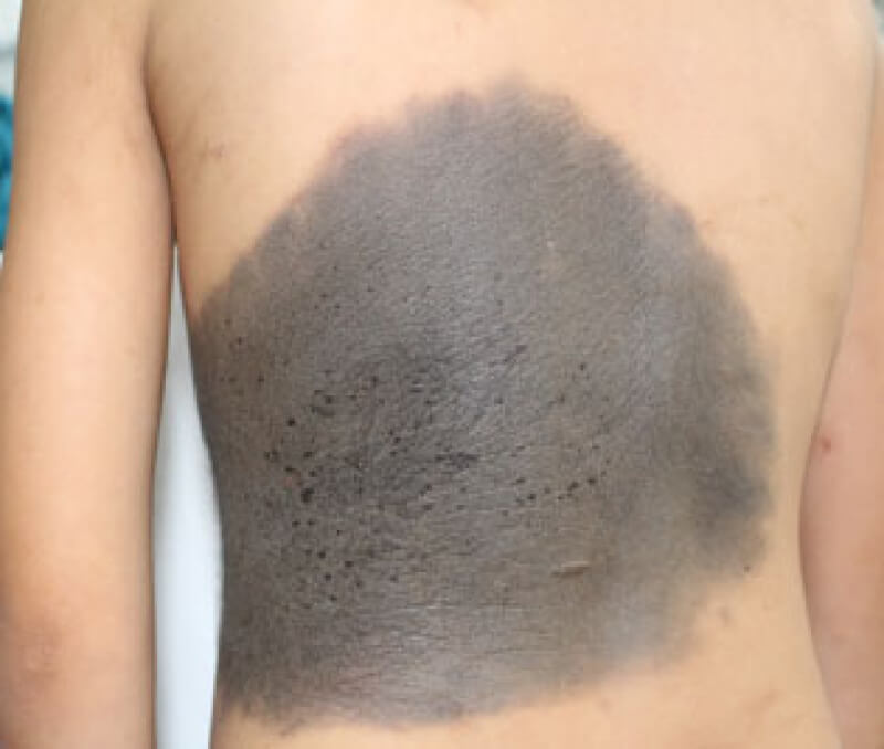 Vết bớt màu đen 2