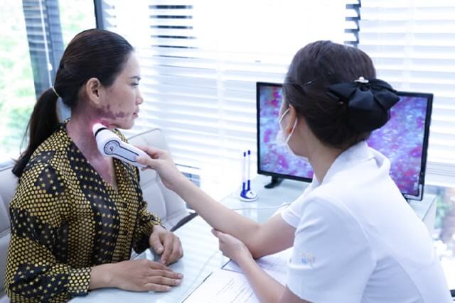 4 cách tẩy/xóa bớt bẩm sinh phổ biến hiện nay